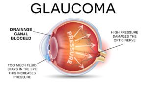 Graphic of Eye with Glaucoma